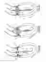 Fig. 18 - Implantable prosthetic valve for treating aortic stenosis