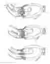 Fig. 19 - Implantable prosthetic valve for treating aortic stenosis