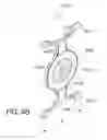 Fig. 47 - Masked intraocular implants and lenses