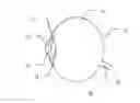 Fig. 01 - COMPOUND MICRO LENS IMPLANT