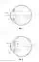 Fig. 02 - Intraocular lens and methods for providing accommodative vision