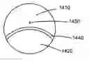 Fig. 01 - Multifocal lens having a progressive optical power region and a discontinuity