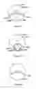 Fig. 10 - Multifocal lens having a progressive optical power region and a discontinuity