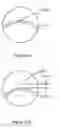 Fig. 18 - Multifocal lens having a progressive optical power region and a discontinuity