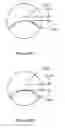 Fig. 20 - Multifocal lens having a progressive optical power region and a discontinuity