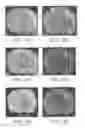 Fig. 04 - Use of functionalized magnetic nanoparticles in cancer detection and treatment