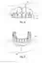 Fig. 03 - Dental prosthesis removal tool