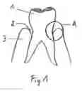 Fig. 02 - Pasty Insert Material for Widening of Gingival Sulcus and Use Thereof