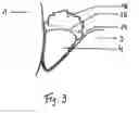 Fig. 04 - Pasty Insert Material for Widening of Gingival Sulcus and Use Thereof