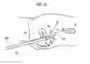 Fig. 09 - INSERTION PATH SECURING APPARATUS AND MANTLE TUBE