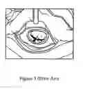 Fig. 03 - Cardiac tissue retractor with associated valve cusp depressor
