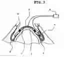 Fig. 03 - Method of measuring electrical resistance value of corneal trans-epithelium