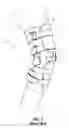 Fig. 02 - Cable-based orthopedic bracing system