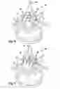 Fig. 06 - Floating spinal cannula and method of use