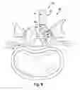 Fig. 08 - Floating spinal cannula and method of use