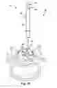 Fig. 09 - Floating spinal cannula and method of use