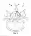Fig. 10 - Floating spinal cannula and method of use