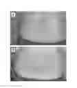 Fig. 07 - Skin patch instrument for treating pain