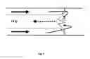 Fig. 05 - INDWELLING CATHETER