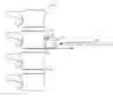 Fig. 01 - Method and apparatus for allograft disc transplantation