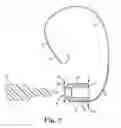 Fig. 03 - Suture assembly and system