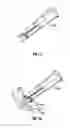 Fig. 11 - Method and apparatus for meniscal repair