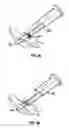 Fig. 17 - Method and apparatus for meniscal repair