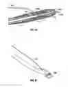 Fig. 43 - Method and apparatus for meniscal repair