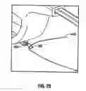 Fig. 56 - Method and apparatus for meniscal repair