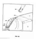 Fig. 75 - Method and apparatus for meniscal repair