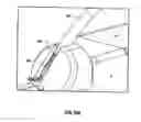 Fig. 76 - Method and apparatus for meniscal repair
