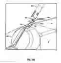 Fig. 77 - Method and apparatus for meniscal repair