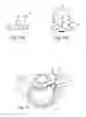 Fig. 04 - System and devices for the repair of a vertebral disc defect