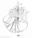 Fig. 33 - Instruments and methods for minimally invasive carpal tunnel release