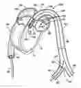 Fig. 01 - Apparatus for Implanting an Aortic Valve Prosthesis