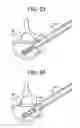 Fig. 09 - Methods and apparatuses for bone restoration