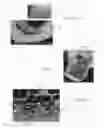 Fig. 06 - Total disc implant