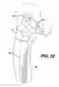 Fig. 22 - Instrument and associated method of trialing for modular hip stems