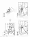 Fig. 11 - Method for forming an interventional aid with the aid of self-organizing nanorobots consisting of catoms and associated system unit