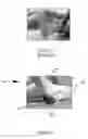 Fig. 02 - Method and compression hose for relieving heel pressure