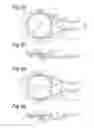 Fig. 03 - SECURING DEVICE AND ASSEMBLY COMPRISING SUCH A SECURING DEVICE
