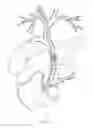 Fig. 03 - Occlusion device