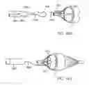 Fig. 43 - EMBOLIC PROTECTION METHOD
