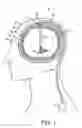 Fig. 02 - Burr hole sealing device for preventing brain shift