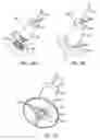 Fig. 08 - Burr hole sealing device for preventing brain shift
