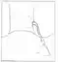 Fig. 01 - Devices and Methods for Occluding a Fistula
