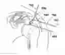 Fig. 01 - IMPLANTABLE PROSTHETIC CORD