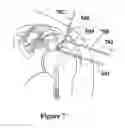 Fig. 12 - IMPLANTABLE PROSTHETIC CORD