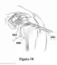 Fig. 15 - IMPLANTABLE PROSTHETIC CORD