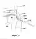 Fig. 16 - IMPLANTABLE PROSTHETIC CORD